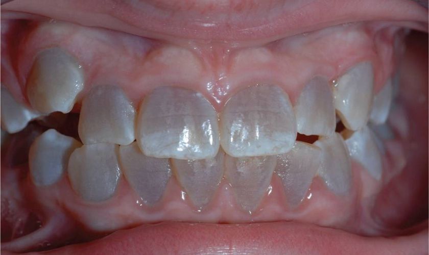 Teeth Gray treatment