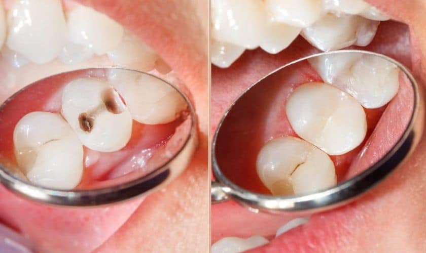 Dental Composite fillings