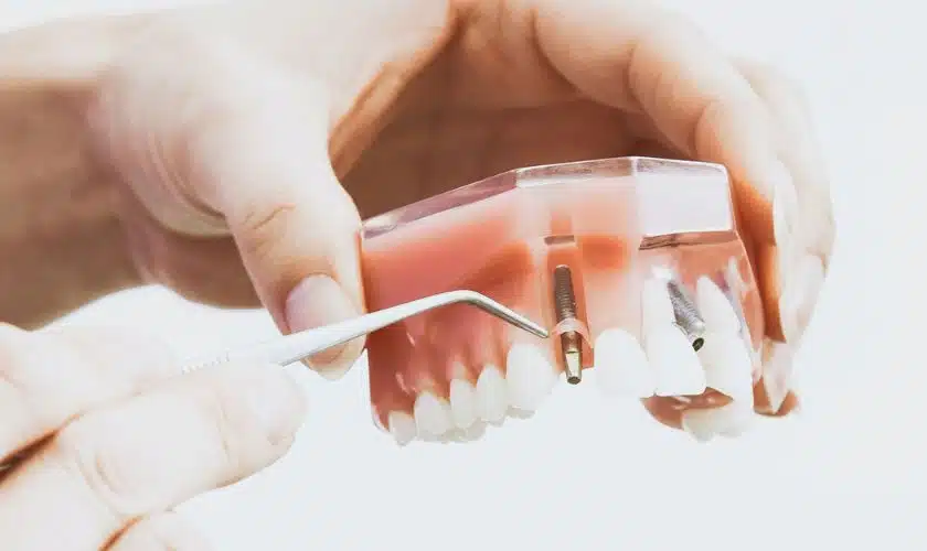 Dental Implant Gainesville