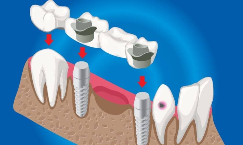 Smile Restoration: Exploring the Benefits of Dental Bridges - Saddlebrook Dental & Orthodontics