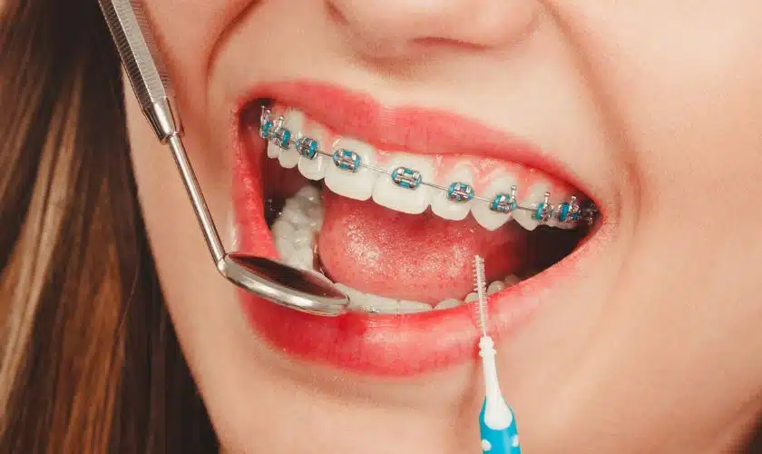 Featured image for “How Adult Braces Can Improve Oral Health in Gainesville”