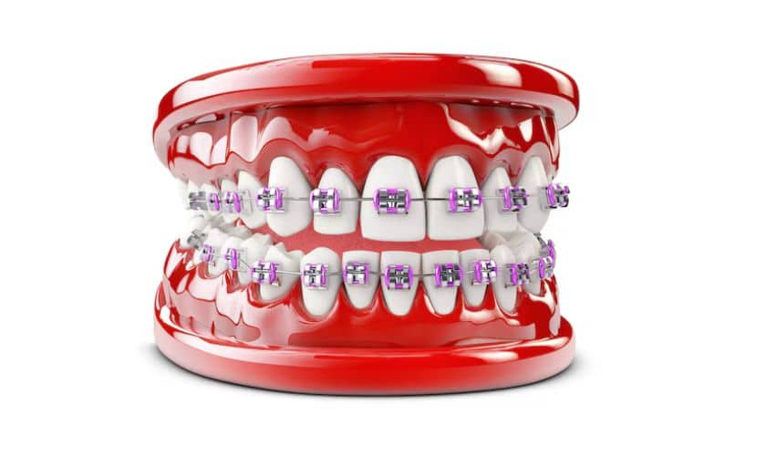 Featured image for “Traditional Braces vs. Modern Options: Choosing the Right Treatment in Gainesville”